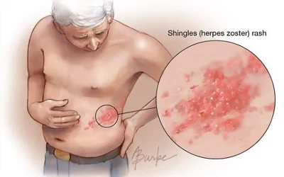 Az övsömör (Herpes zoster)